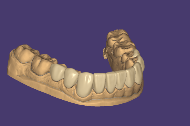 Veneers - CadCam Masters