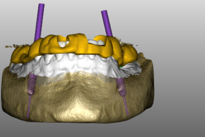 Implant Planning+Surgical Guide - CadCam Masters
