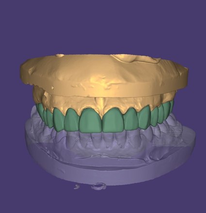 crown and bridges - CadCam Masters