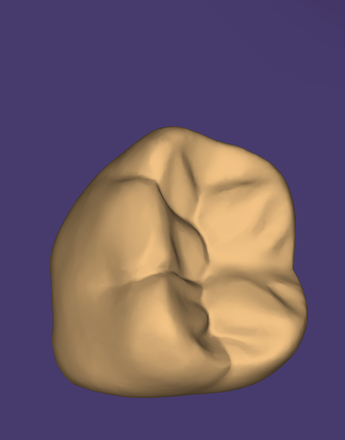 Digital wax up - CadCam Masters