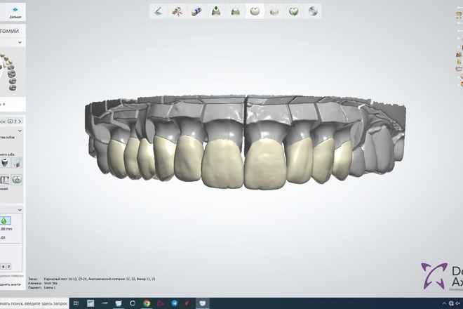 crown, veneer design - CadCam Masters