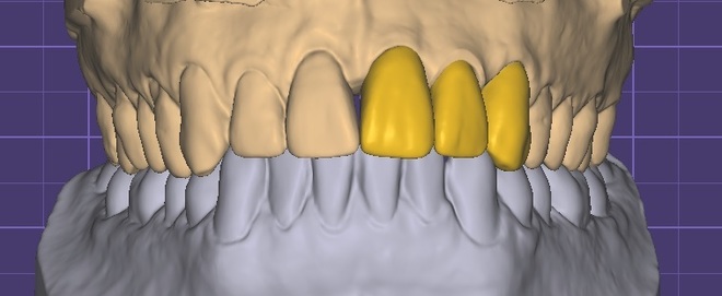 Anatomic crowns/bridges - CadCam Masters