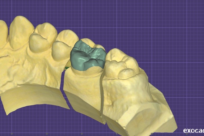 Inlays/onlays - CadCam Masters