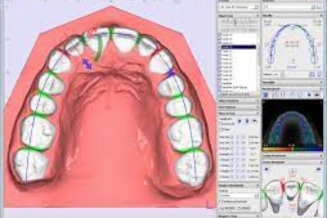 Treatment planning of clear orthodontic aligners - CadCam Masters