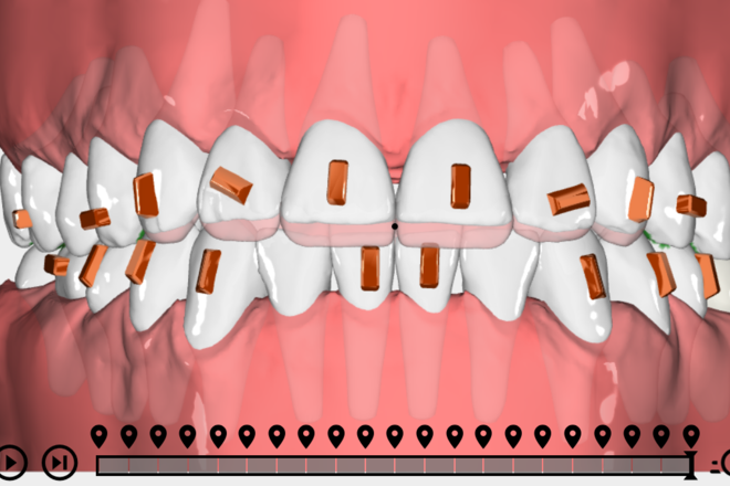 Clear aligner orthodontic treatment - CadCam Masters