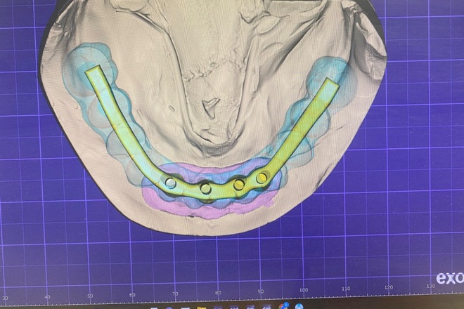 Implant Bars - CadCam Masters
