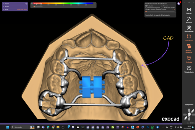 Digital expander - CadCam Masters