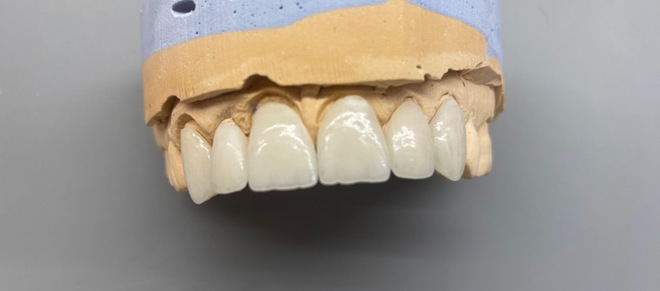 Veneers - CadCam Masters