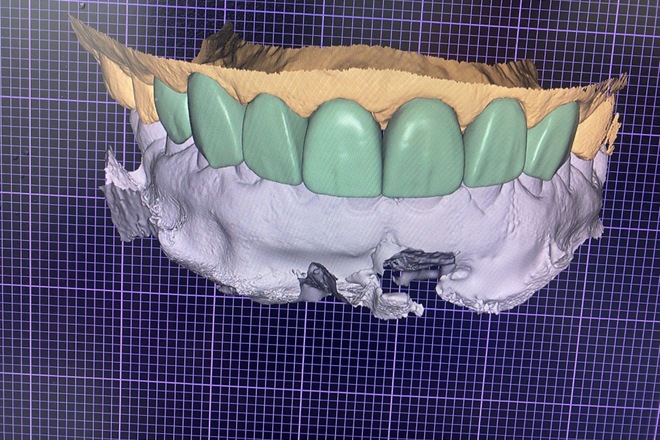 Exo cad designs - CadCam Masters