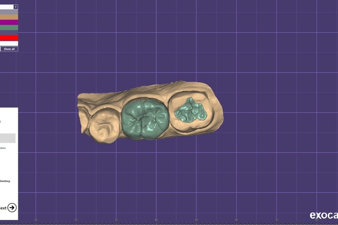 Onlays and inlays - CadCam Masters
