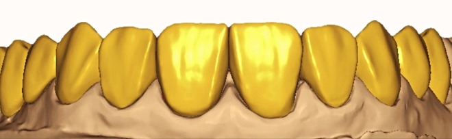 Full arch over implant and full mouth cases with DSD - CadCam Masters