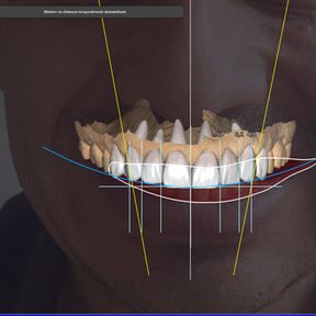 Veneers - CadCam Masters