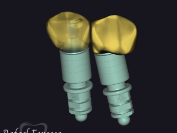 Dental Cad Service: IMPLANT CROWNS