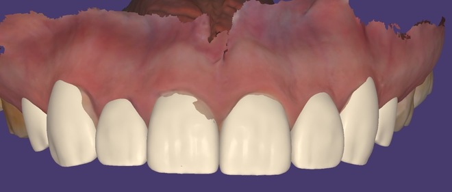 Wax up (per tooth) - CadCam Masters