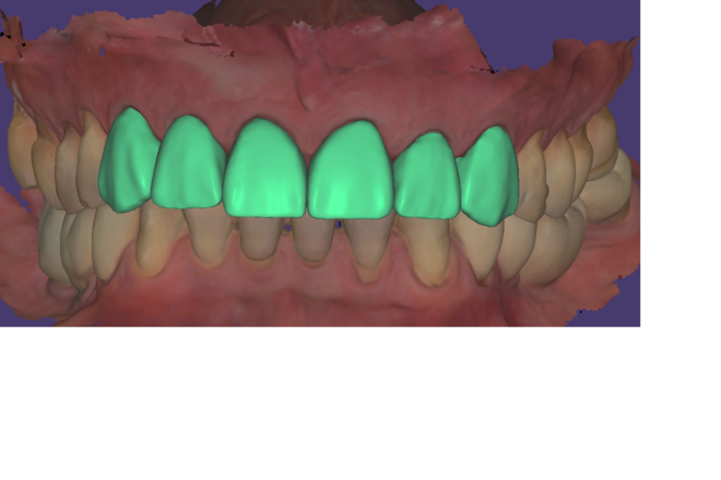 wax up for mock up 6/8 units - CadCam Masters