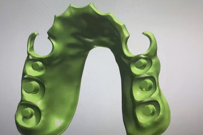 Acrylic Partial Denture Dental Design (Flipper)