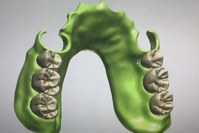 Acrylic Partial Denture Dental Design (Flipper)