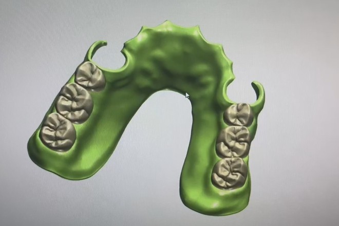 Acrylic Partial Denture Dental Design (Flipper)