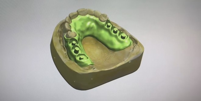 Flipper Acrylic Partial Denture Dental Design