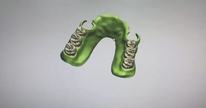Flipper Acrylic Partial Denture Dental Design