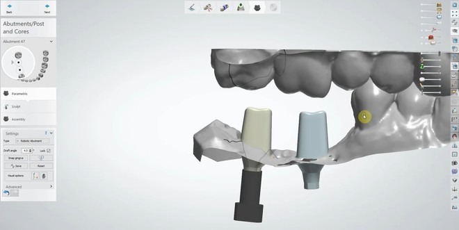 Implant Custom Abutment 3shape Cad Design - CadCam Masters