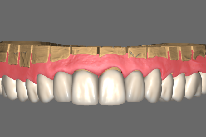 Full contour Crown & Bridge