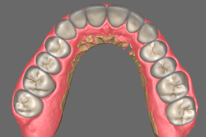 Full contour Crown & Bridge
