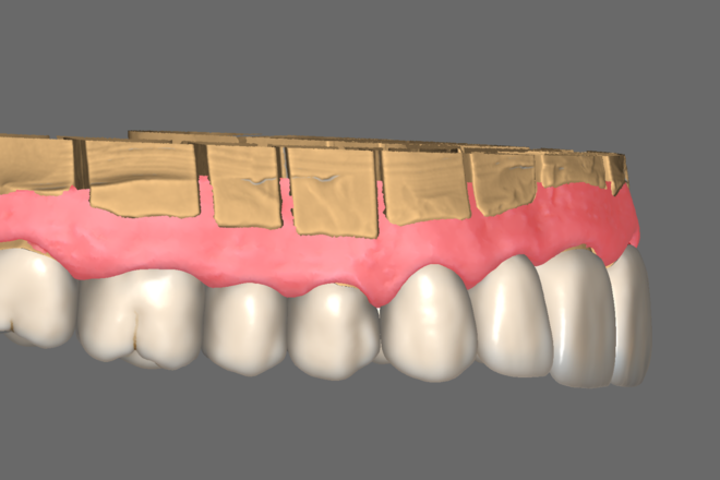 Full contour Crown & Bridge