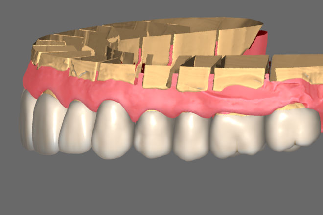 Full contour Crown & Bridge