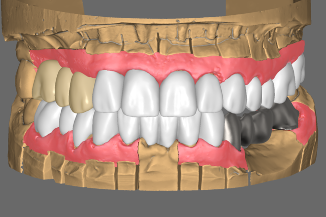 Full contour Crown & Bridge