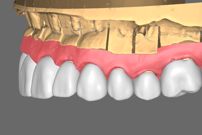 Full contour Crown & Bridge