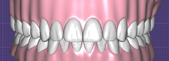 Digital Wax-Up
