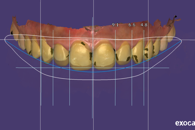 Veneers - CadCam Masters