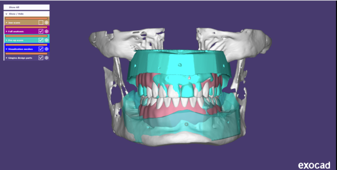 Digital Waxups - CadCam Masters