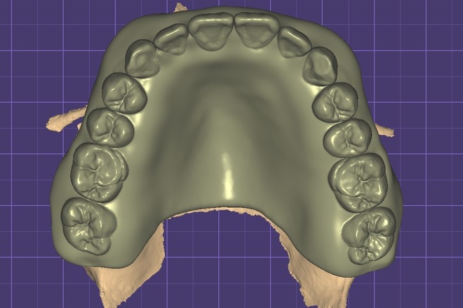 Full Denture - CadCam Masters