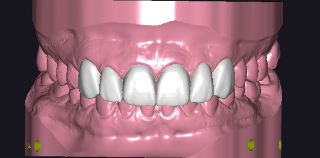 Digital wax up - CadCam Masters