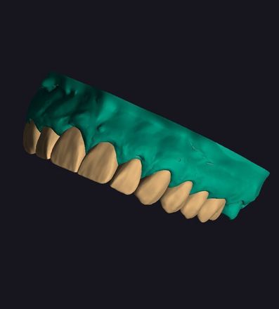 All kinds of projects on exocad