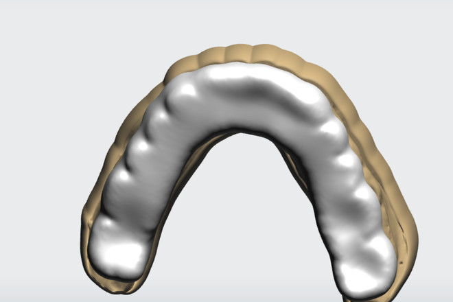 BITE SPLINT Night Guard – CAD Design - CadCam Masters