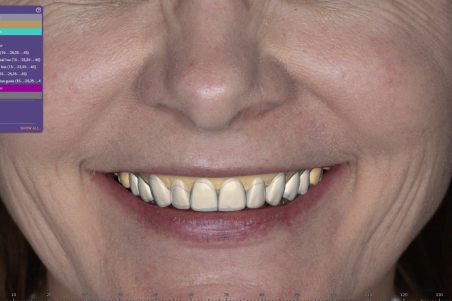 Smile Design Wax Up with FREE Designed Model