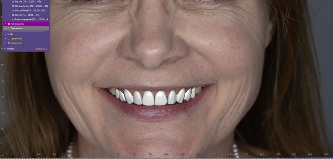 Smile Design Wax Up with FREE Designed Model