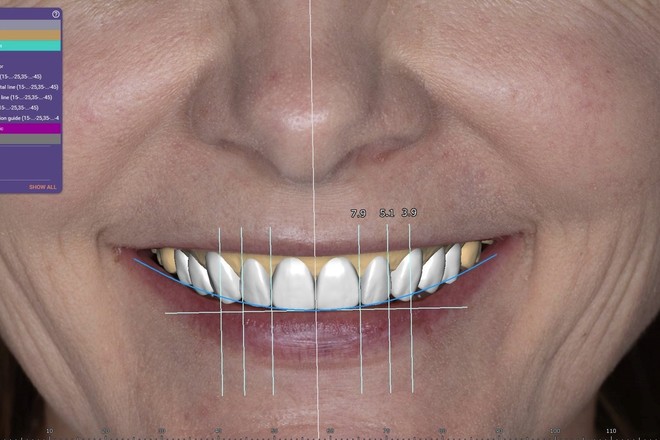 Smile Design Wax Up with FREE Designed Model