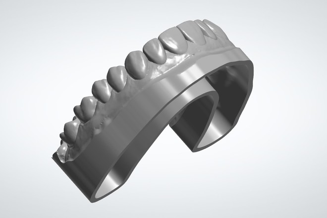 Smile Design Wax Up with FREE Designed Model