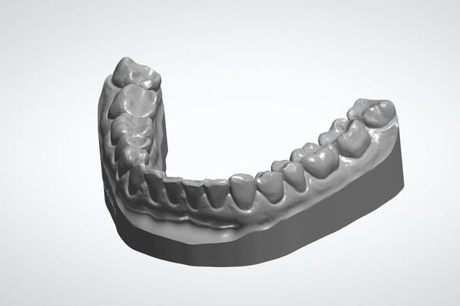 Smile Design Wax Up with FREE Designed Model