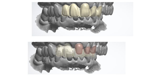 Porcelain Facings with Monolithic Lingual 3shape design - CadCam Masters
