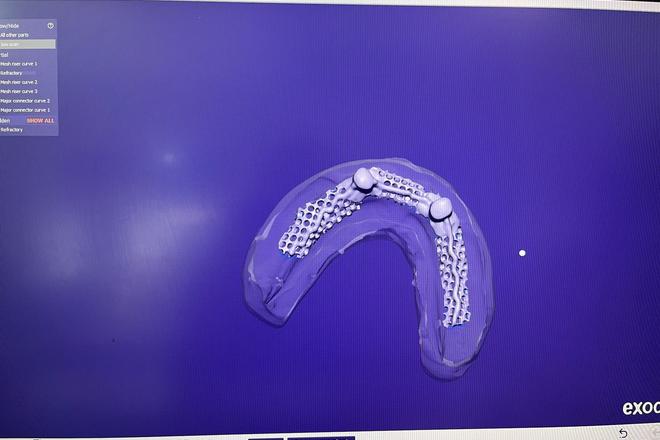 Removable partial frame - CadCam Masters