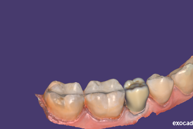 crown & bridge - CadCam Masters