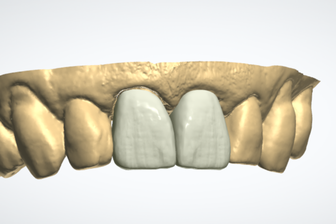 Single Crowns and Bridges - CadCam Masters
