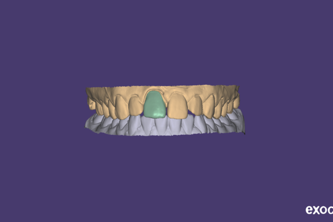 Veneers and Wax up - CadCam Masters
