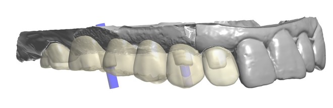 Implant crown - CadCam Masters
