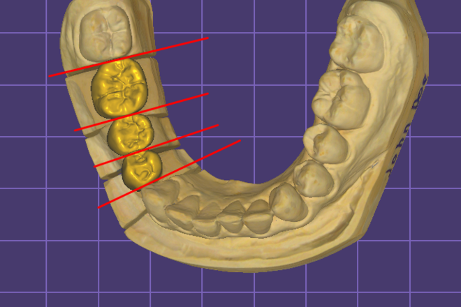 Crown&Bridge - CadCam Masters